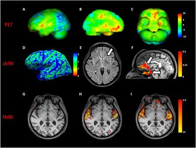 Fronto-Temporal Circuits in Musical Hallucinations: A PET-MR Case Study